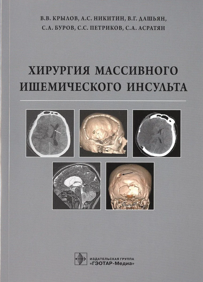 Хирургия массивного ишемического инсульта