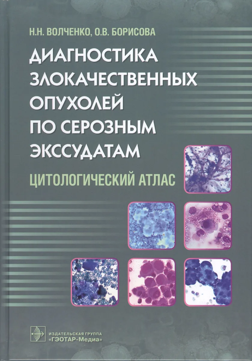 Диагностика злокачественных опухолей по серозным экссудатам.
