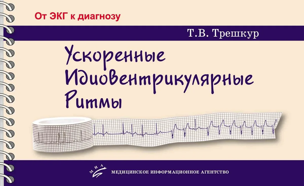 Ускоренные идиовентрикулярные ритмы