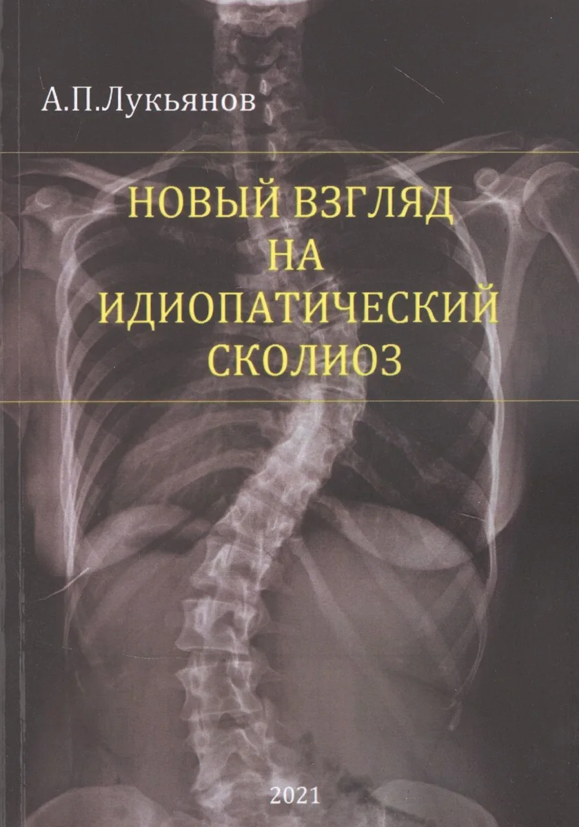 Новый взгляд на идиопатический сколиоз